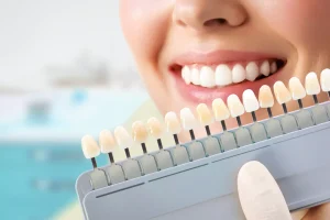 Waxing Eloquent: Why a Digital Wax Up is Essential for Flawless Veneers - Dental Windermere